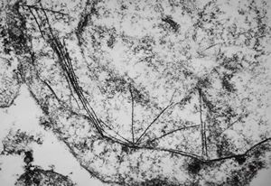 F,76y. | intranuclear needle-like structures - rhabdomyoma,tongue